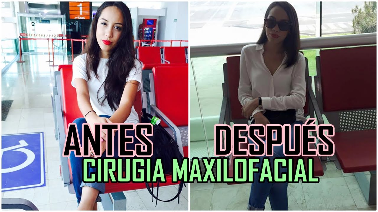 ANTES Y DESPUÉS | CIRUGÍA MAXILOFACIAL♥