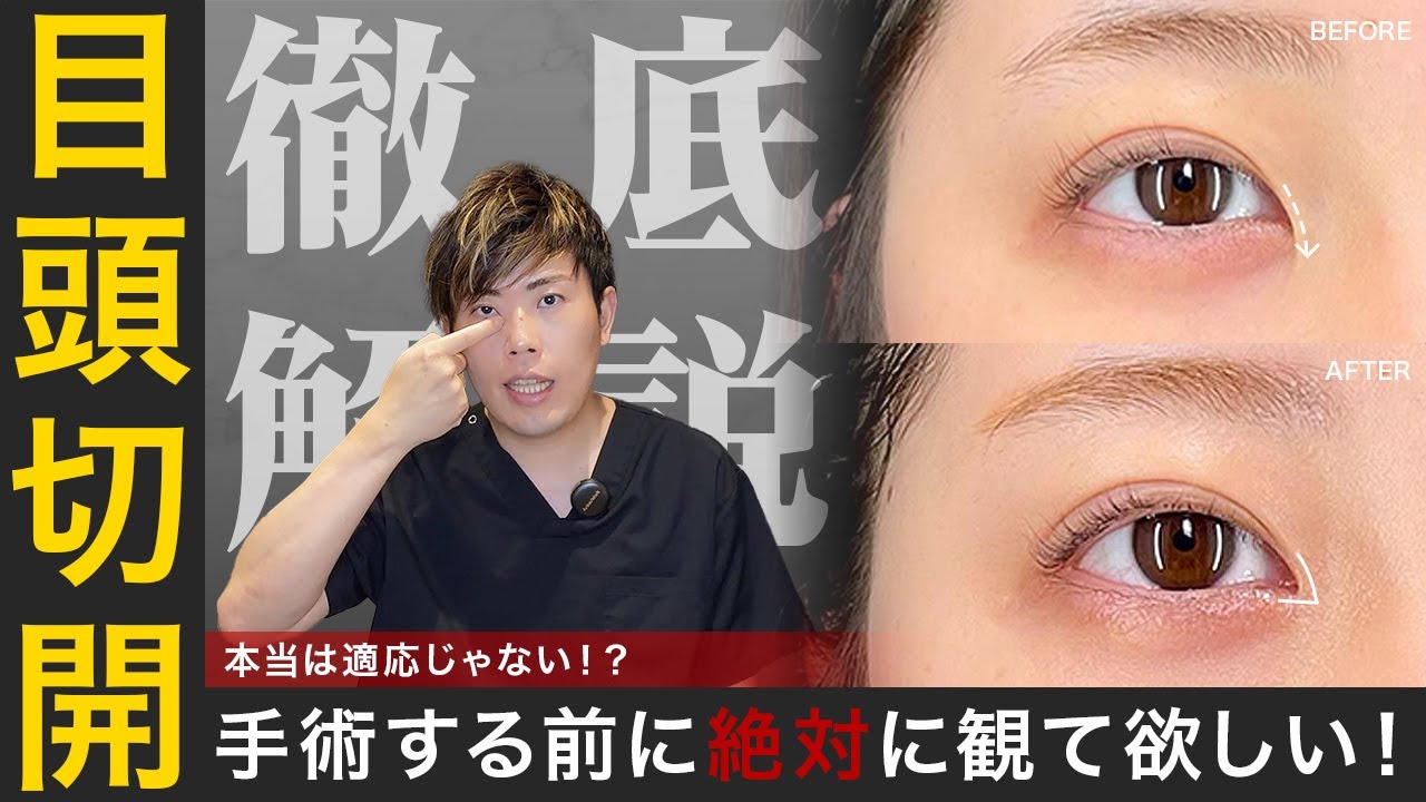 【目頭切開】手術する前に絶対見て!!目頭切開解説