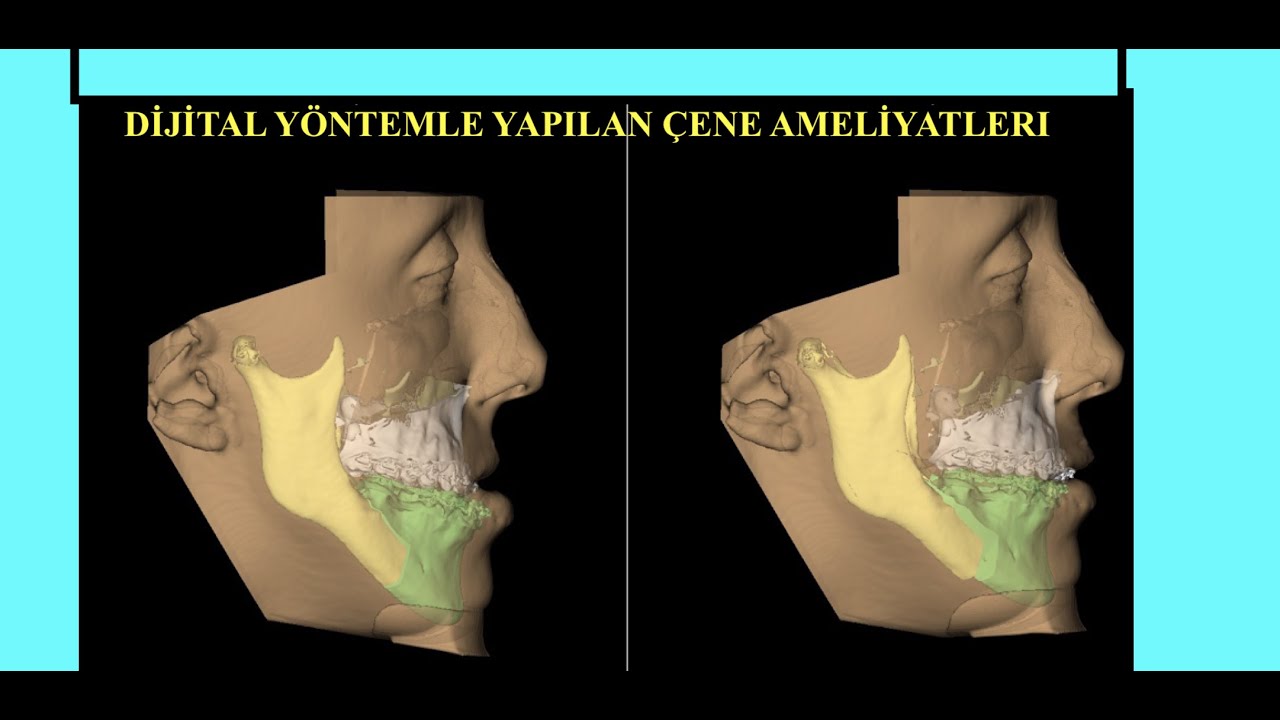 DİJİTAL YÖNTEMLERLE YAPILAN TEK  ÇENE /ÇİFT ÇENE AMELİYATLARI