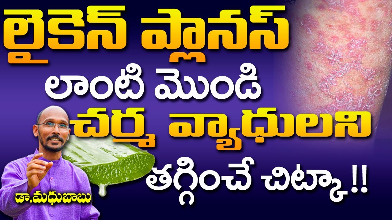 లైకెన్ ప్లానస్ లాంటి మొండి చర్మ వ్యాధులని తగ్గించే చిట్కా | Dr. Madhu Babu| Health Trends |