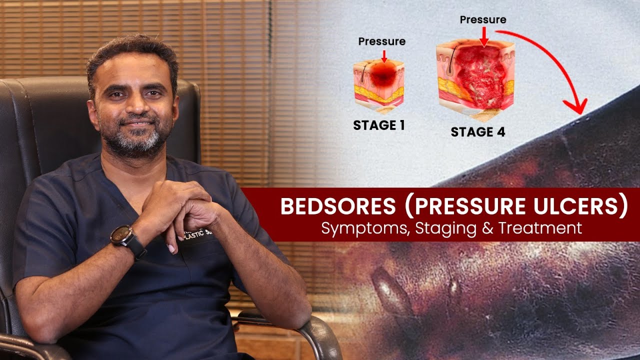 Bedsores ( Pressure Ulcers ) Symptoms , Staging & Treatment | Dr. Sree Charan | Plastic Surgeon