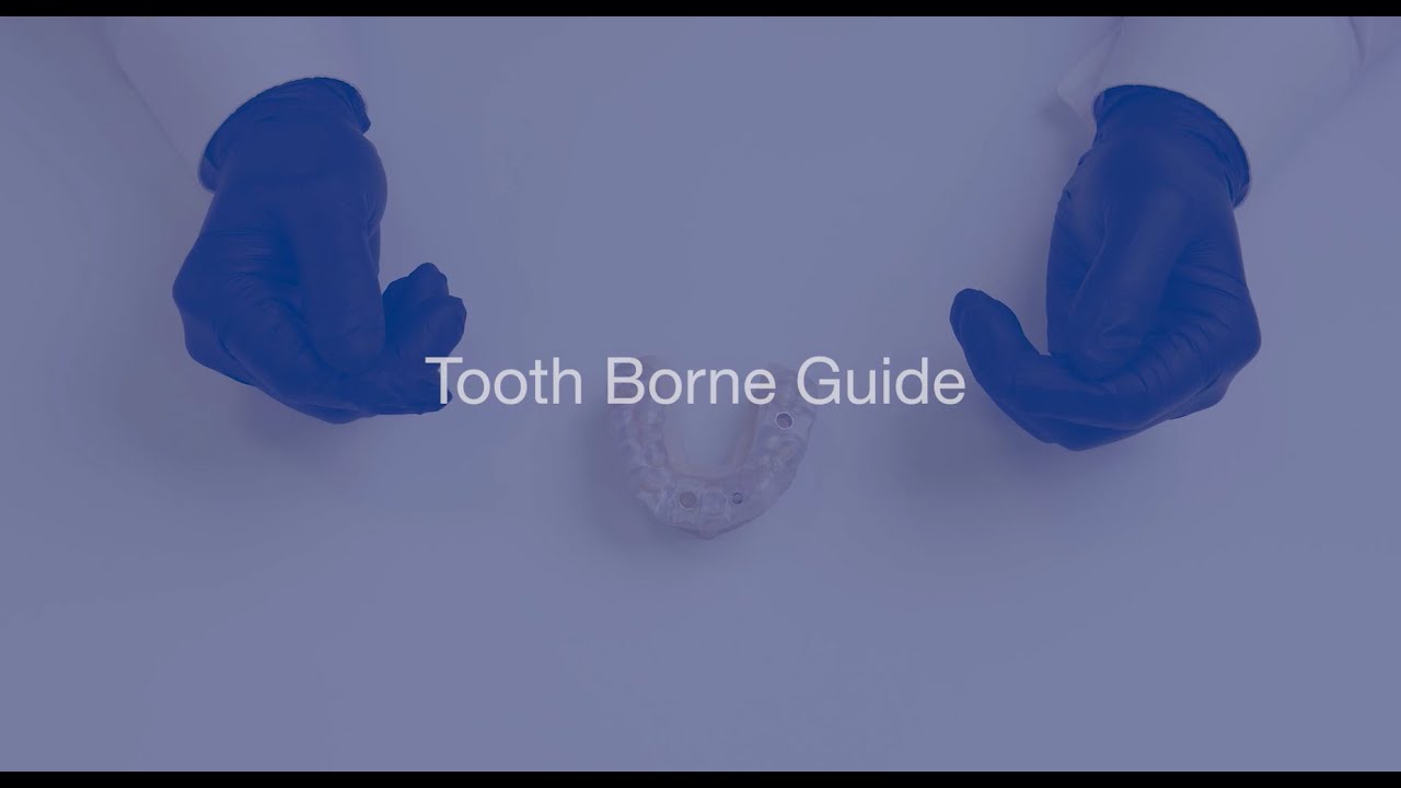 Tooth Borne Surgical Guide