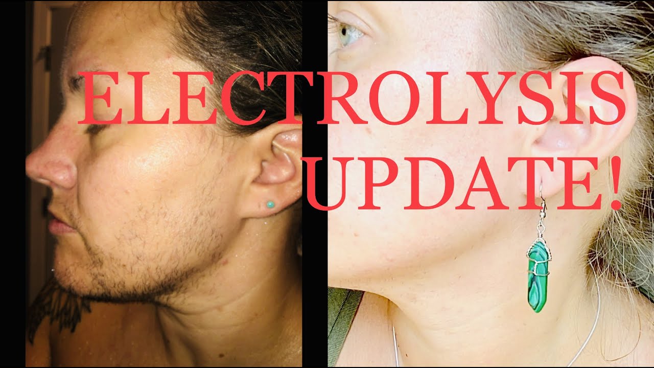 I'm back! 135 hrs of Electrolysis | before & after | PCOS Hirsutism permanent facial hair removal