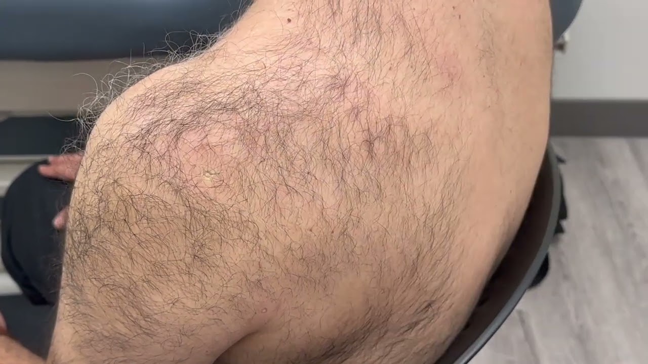 McMaster Medical Acupuncture Program: SI 10