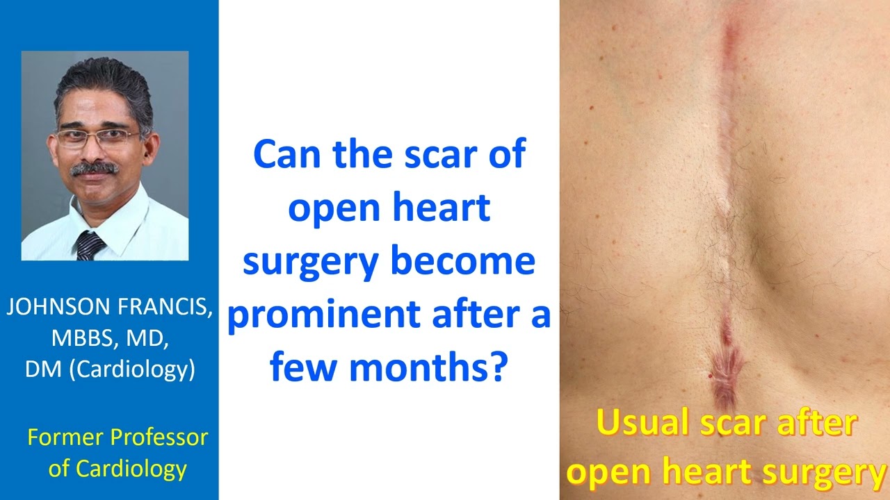 Can the scar of open heart surgery become prominent after a few months?