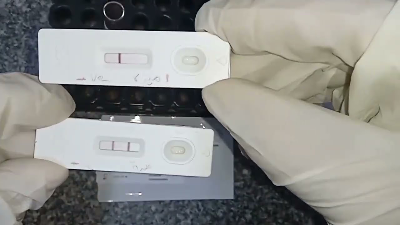 اختبار الحمل في الدم عملي (pregnancy test)ف المعمل