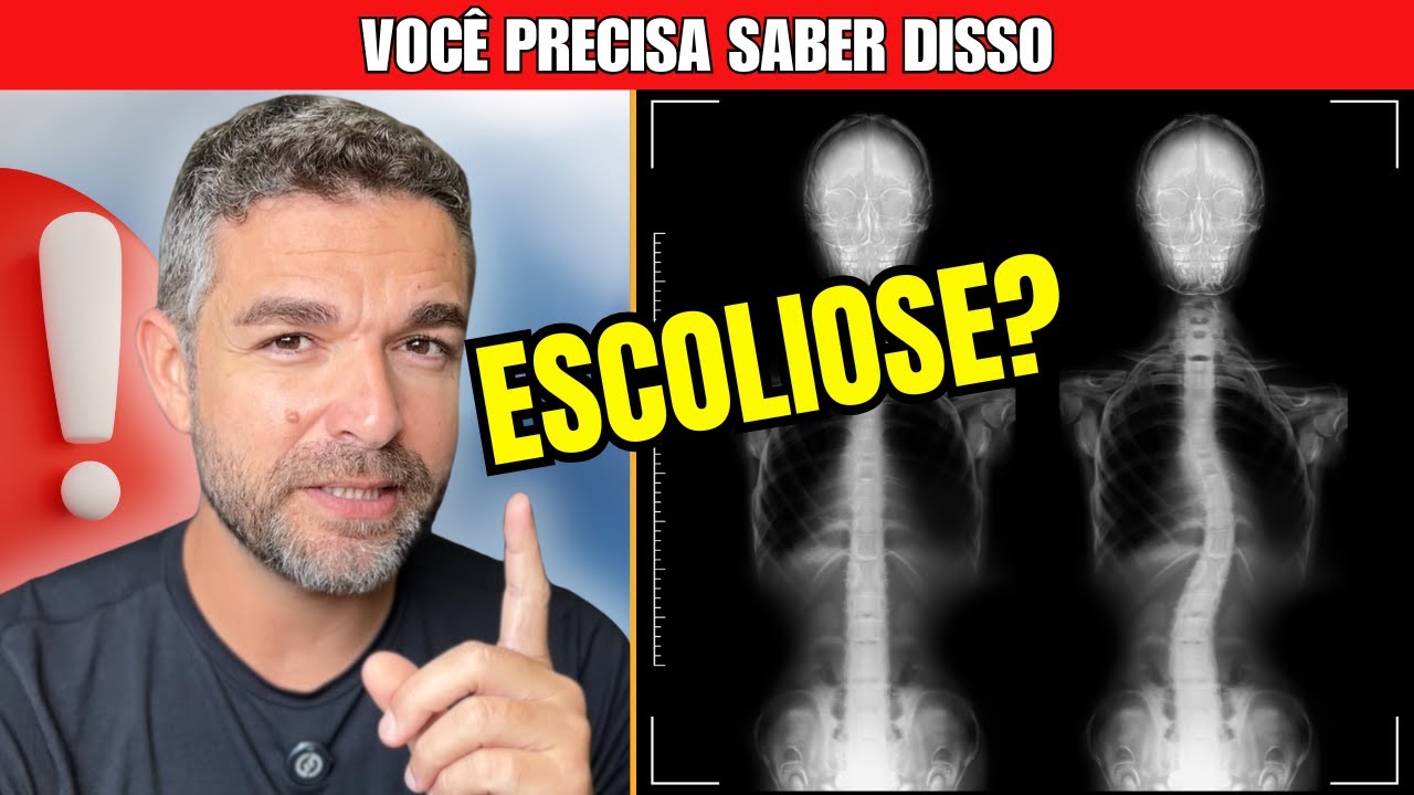 PARE de Acreditar em Mentiras sobre Escoliose
