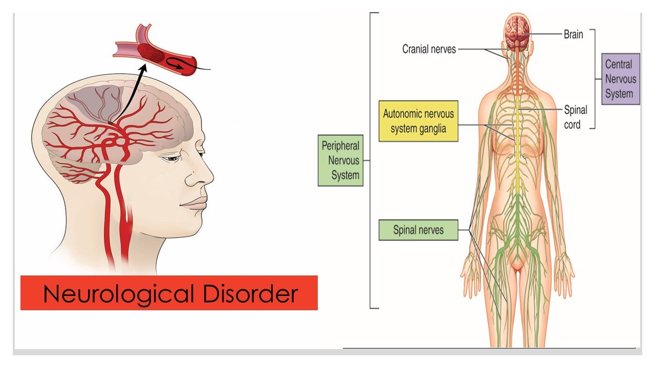 Neurological Disorder/Alzheimer's , Parkinson's , Multiple sclerosis, epilepsy, Migraine, and Stroke