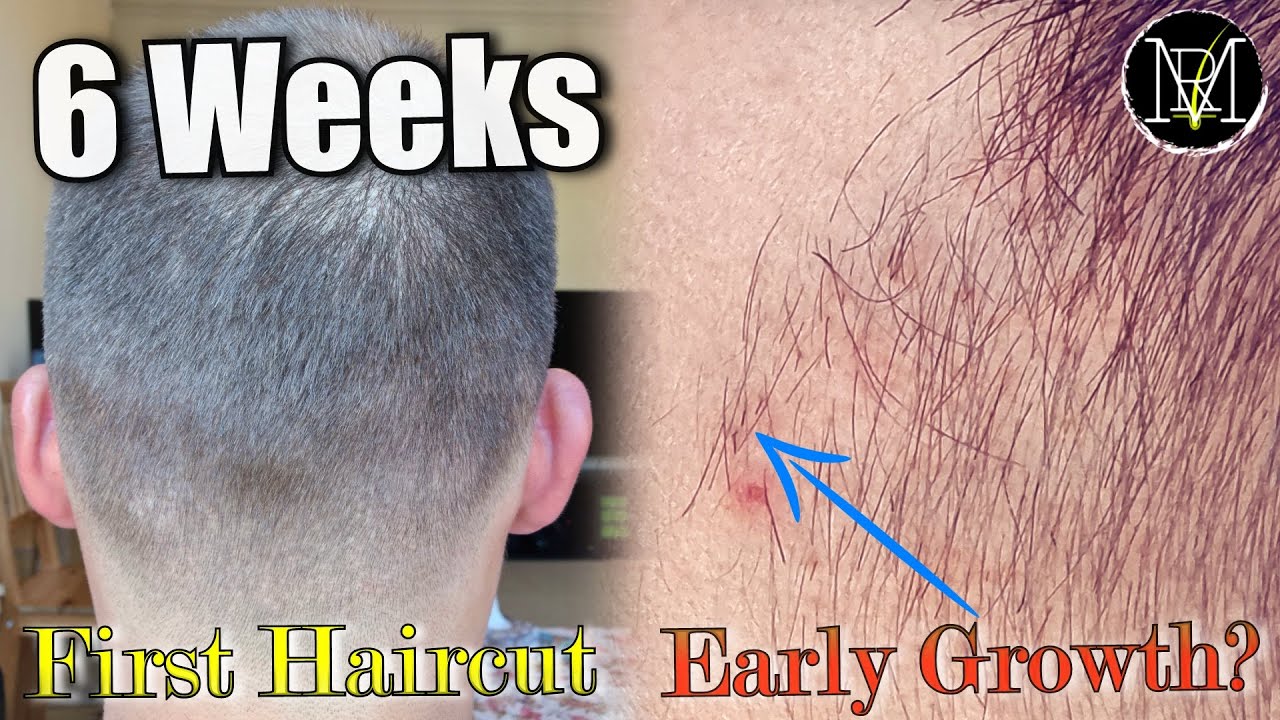 6 weeks after 2nd FUE/DHI. 6500 Grafts, NW5a