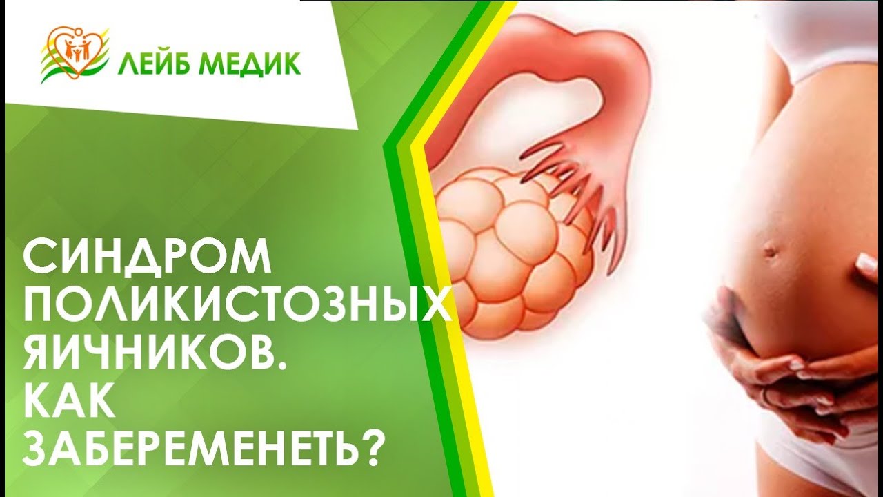 👩‍🦰 Как забеременеть с синдромом поликистозных яичников?