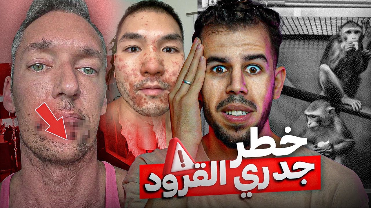 جــدري القرود يهدد العالم, ما القصة ؟