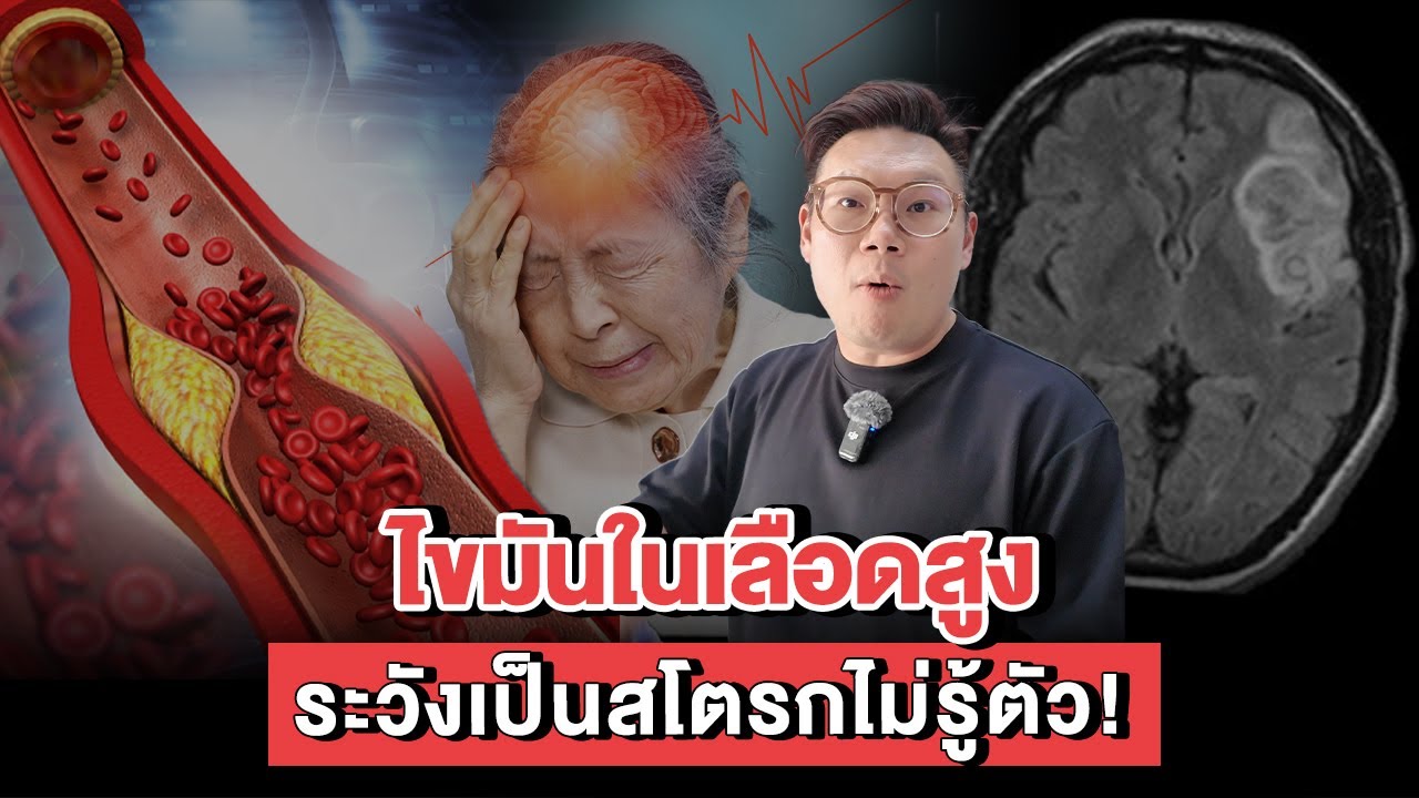 ไขมันในเลือดสูง ระวังเป็นสโตรกไม่รู้ตัว !!! #หมอเจด #หมอเจดสุขภาพ #ไขมันในเลือดสูง #สโตรก #สุขภาพดี