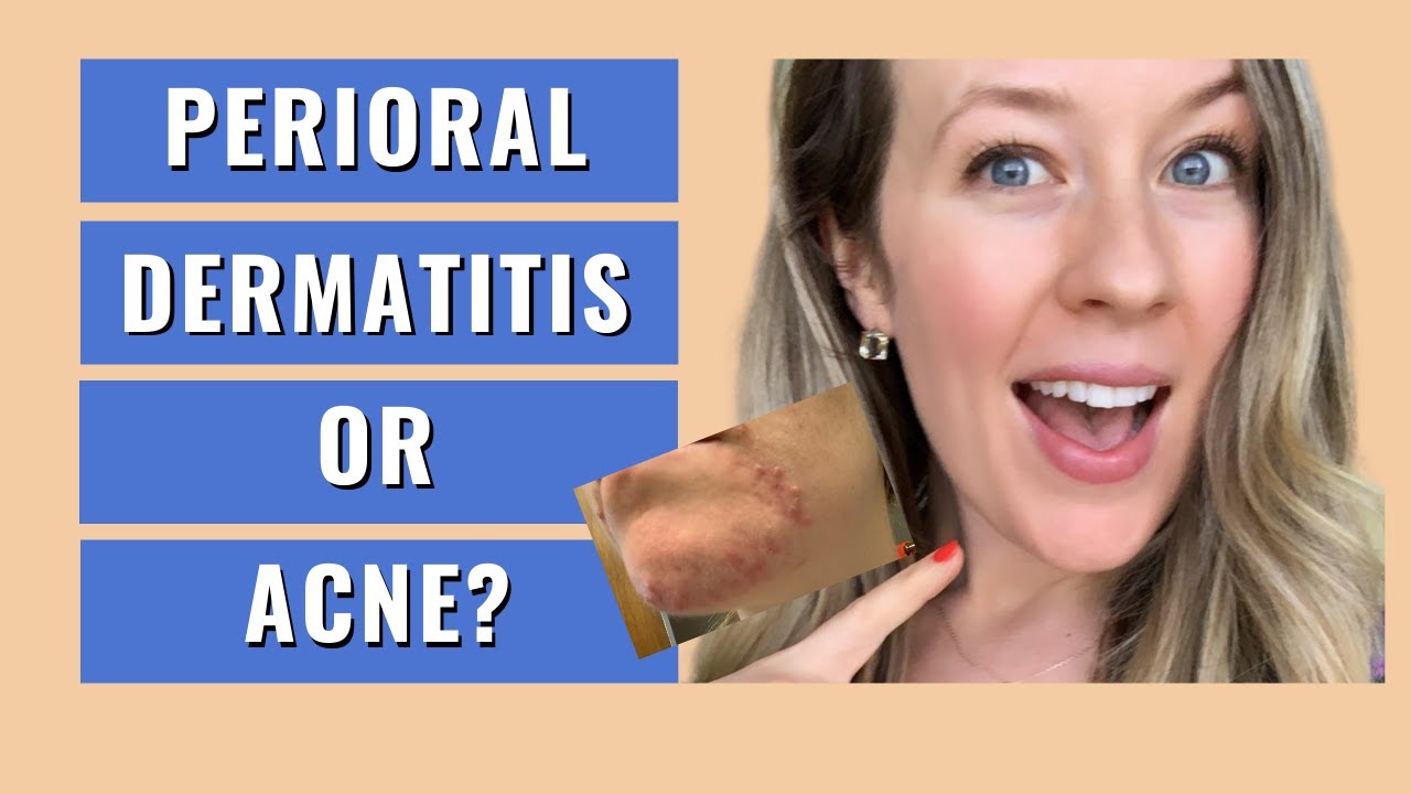 Perioral dermatitis treatment natural - TINY MOUTH BUMPS - ACNE OR PERIORAL DERMATITIS?