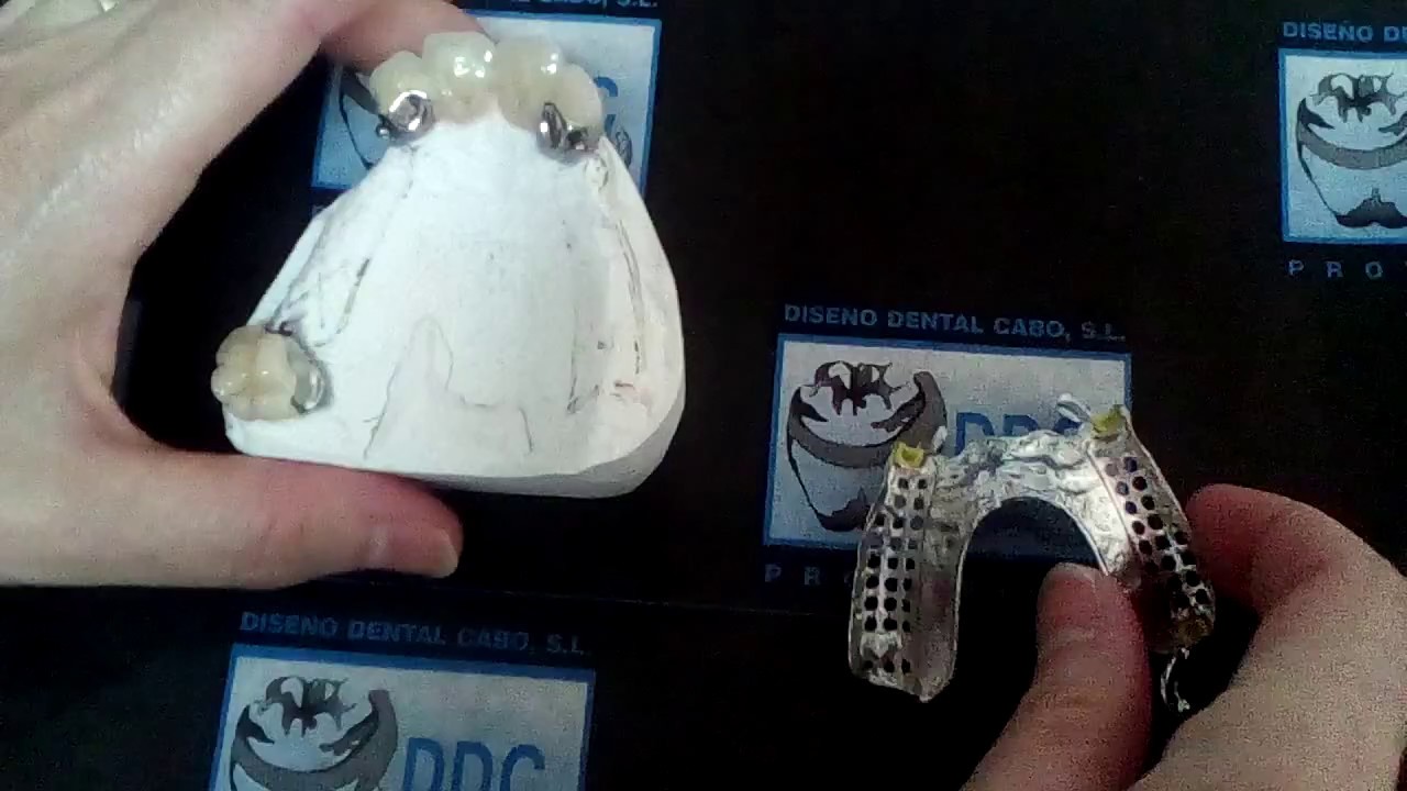 COMO INSERTAR PROTESIS DENTAL ATTACHES