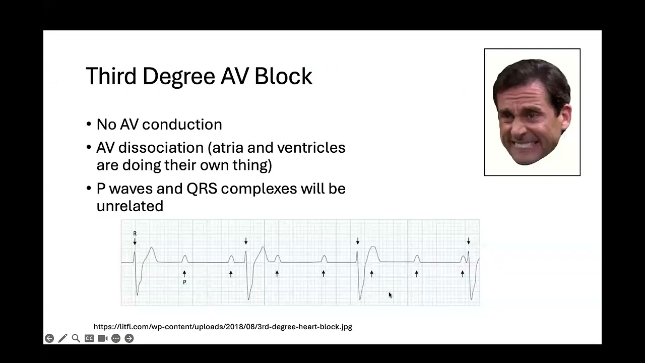 Tuesday Series January 2026 Symptomatic Bradycardia and False Capture