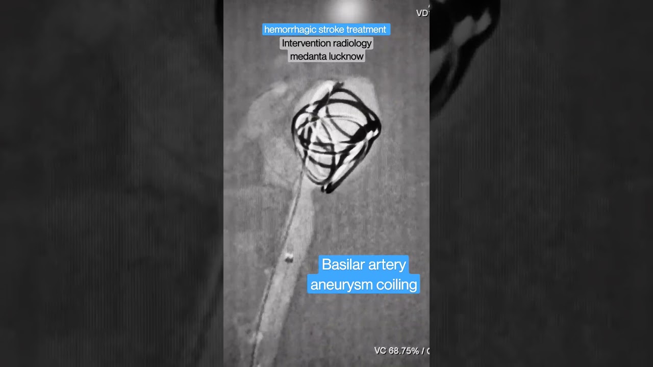 Brain aneurysm coiling#interventionalradiology #medantalucknow #coiling #brainaneurysm