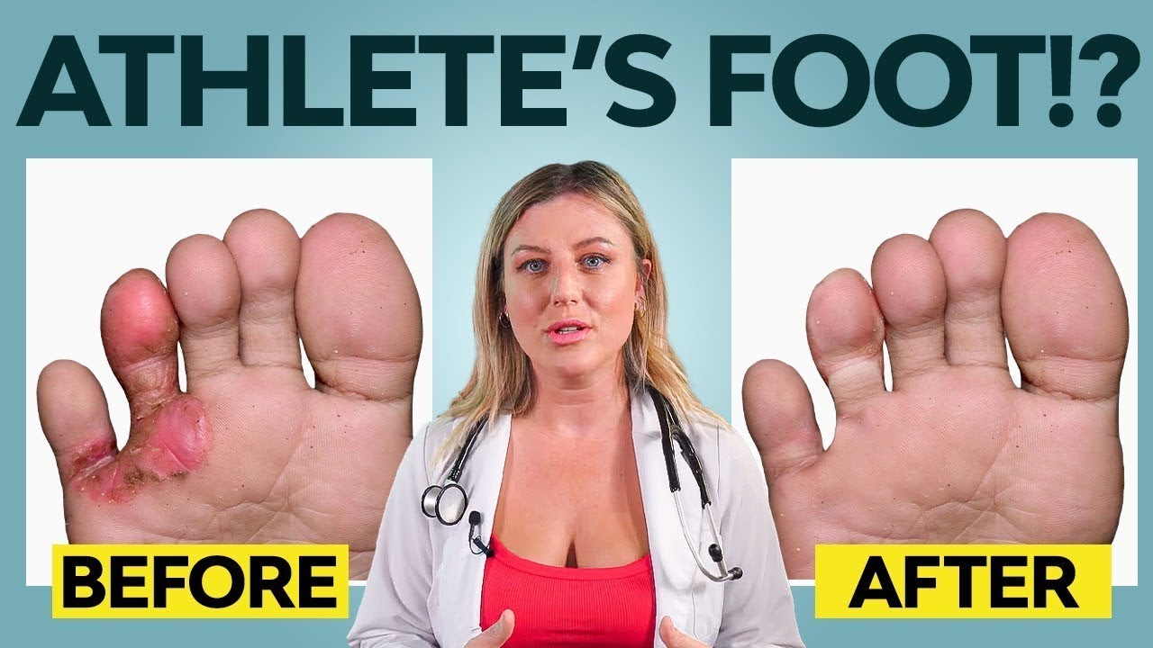 5 Ways to Cure Athlete’s Foot (That Actually Work)