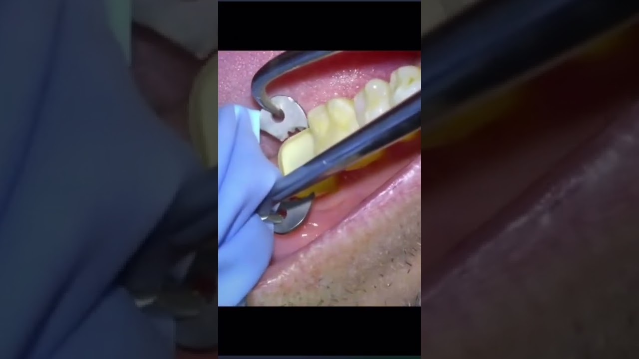 Aislamiento Dental