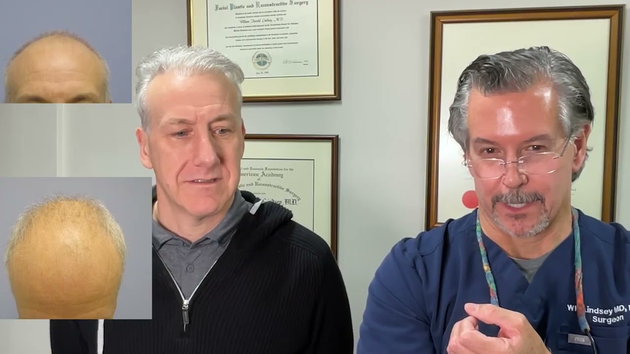 Fantastic hair transplant result by Dr. Lindsey 2 cases, with interview, class 5 hairless | VA | DC