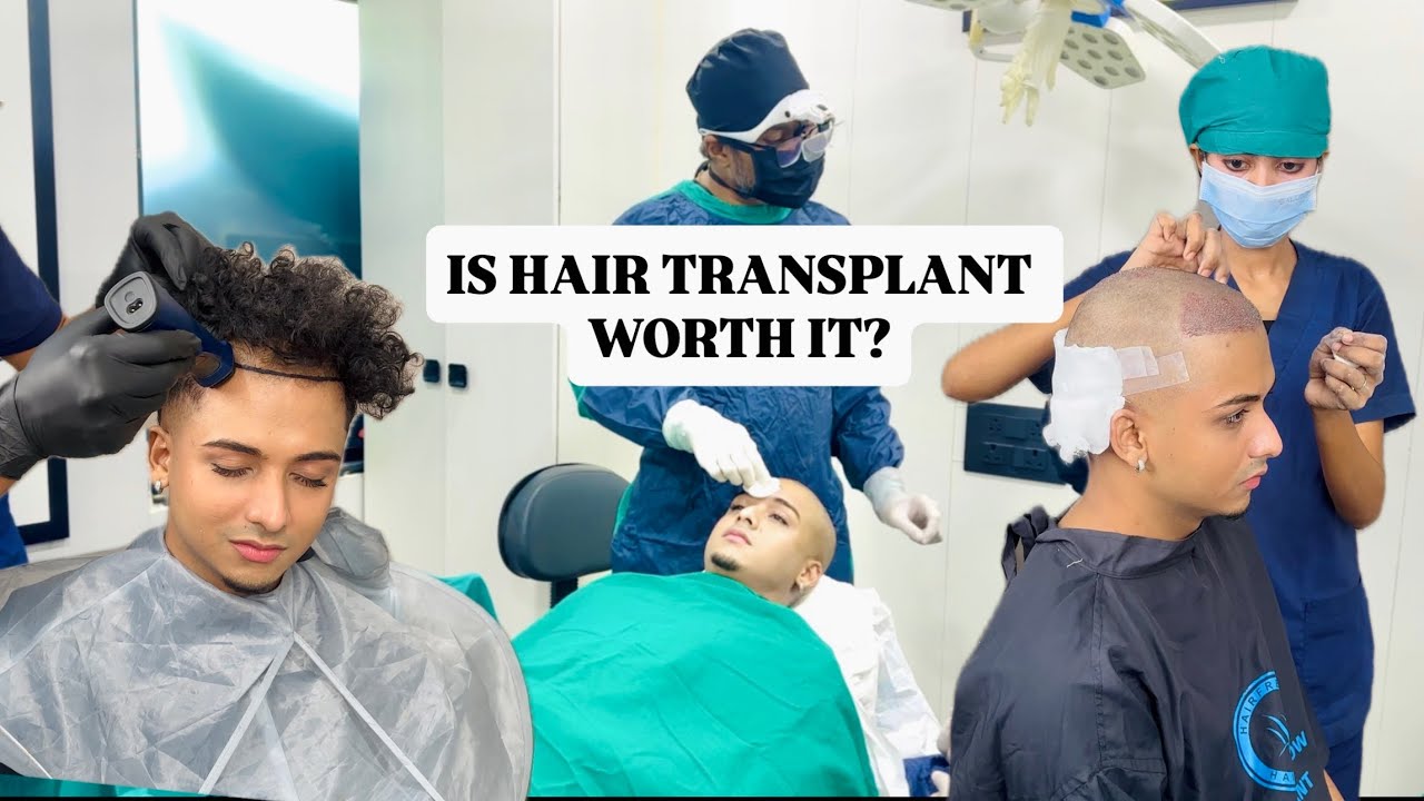 I Did a Hair Transplant… Here’s the Truth | REXXA |