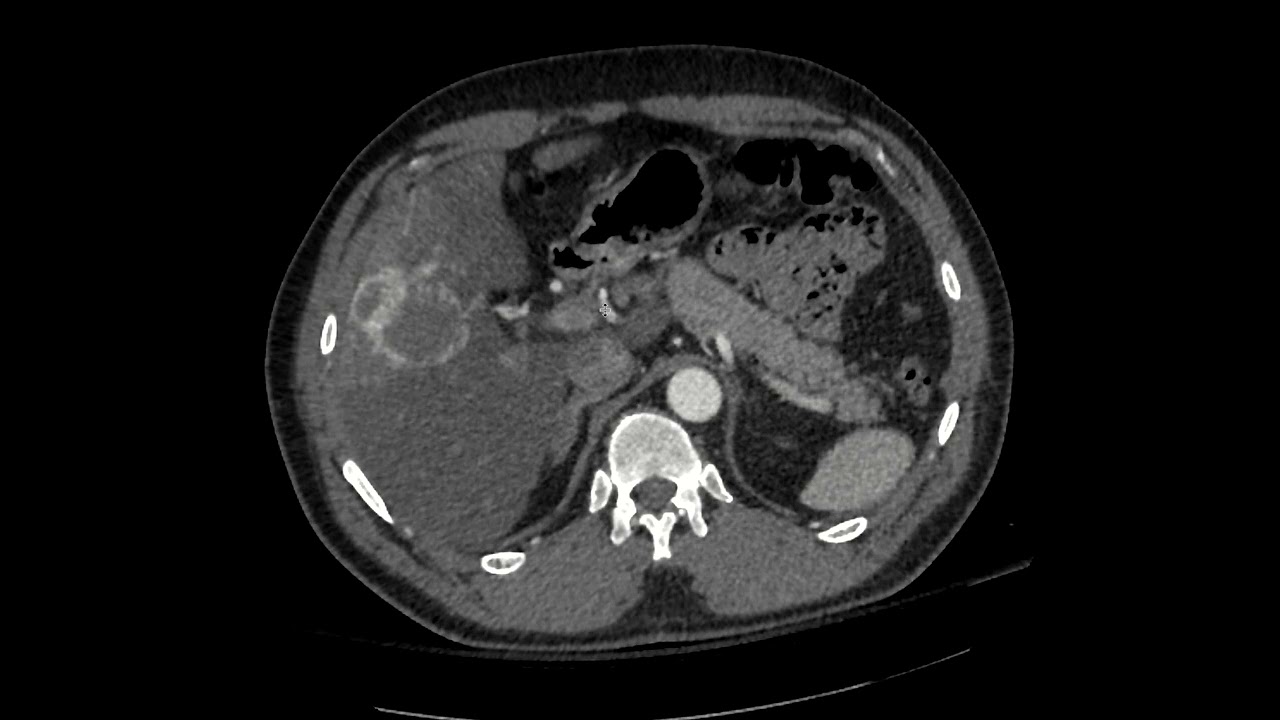 Replaced left and accessory right hepatic artery on CT