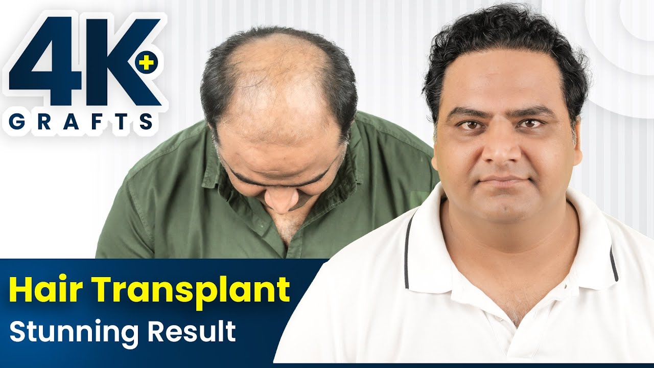 Best Hair Transplant in Hyderabad | Hair Transplant Results & Cost in Hyderabad #hairtransplant