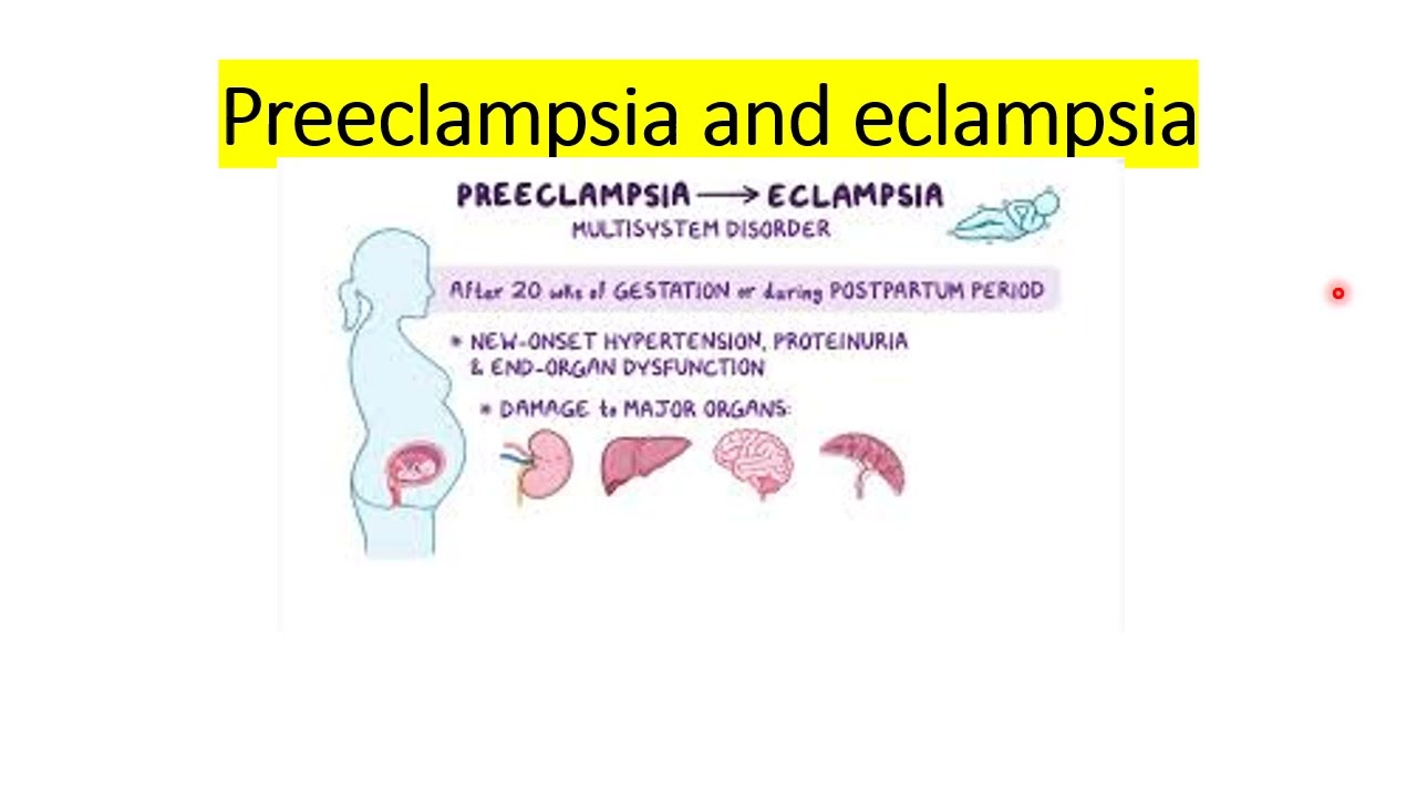 ASPIRATION  during anesthesia and Preclampsia