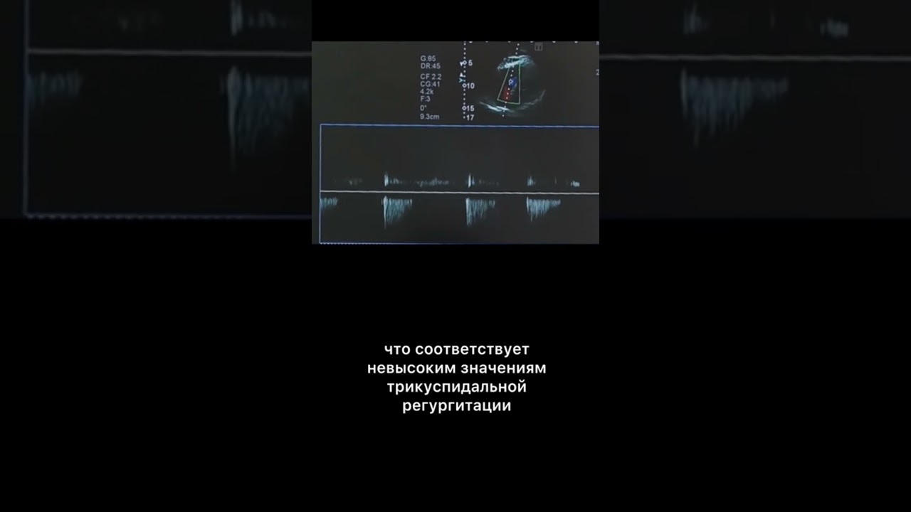 #узи #трикуспидальнаярегургитация
