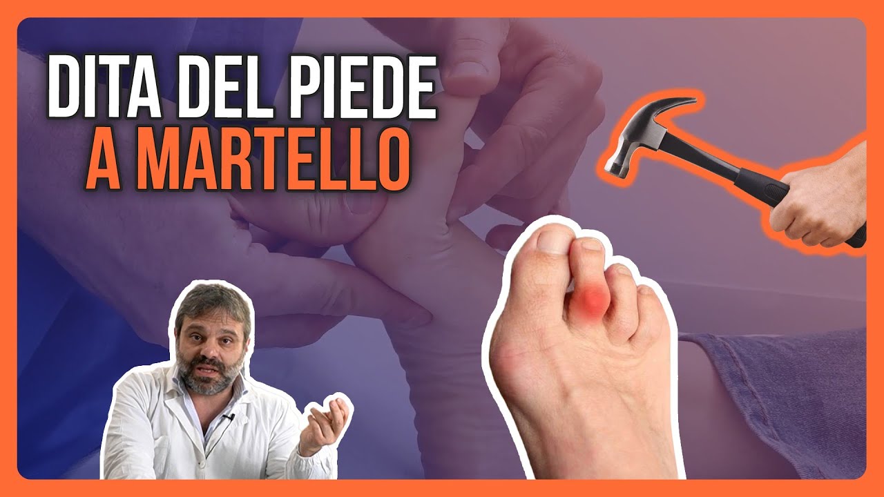 DITO a MARTELLO, ALLUCE VALGO e DOLORE | ESEMPIO di TRATTAMENTO