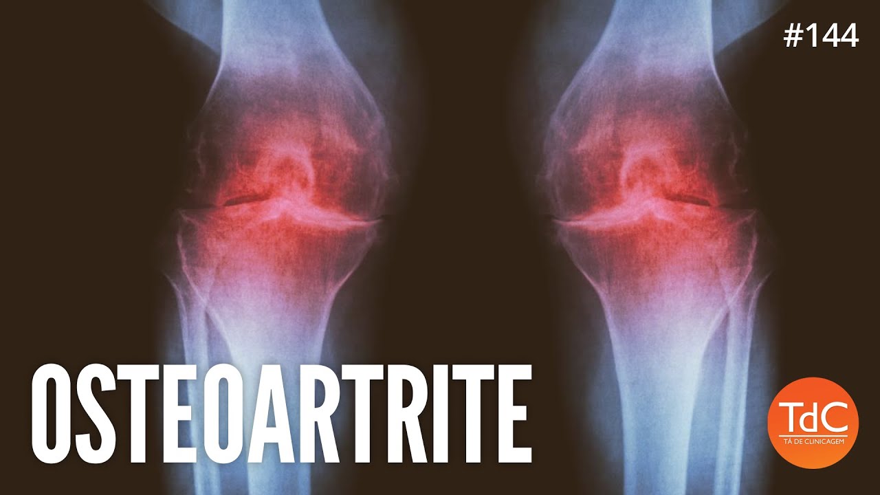 Osteoartrite - Epis&oacute;dio 144