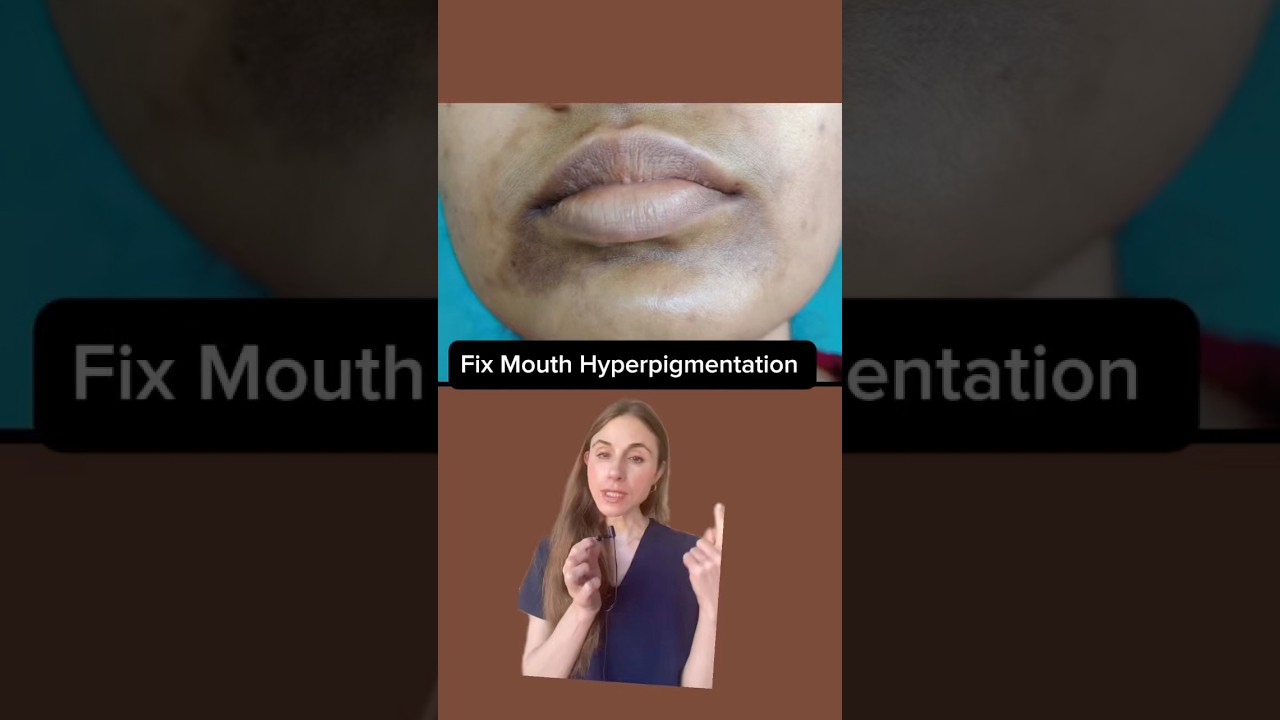 Remove Dark Patches Around Your Mouth Forever #dermatologist