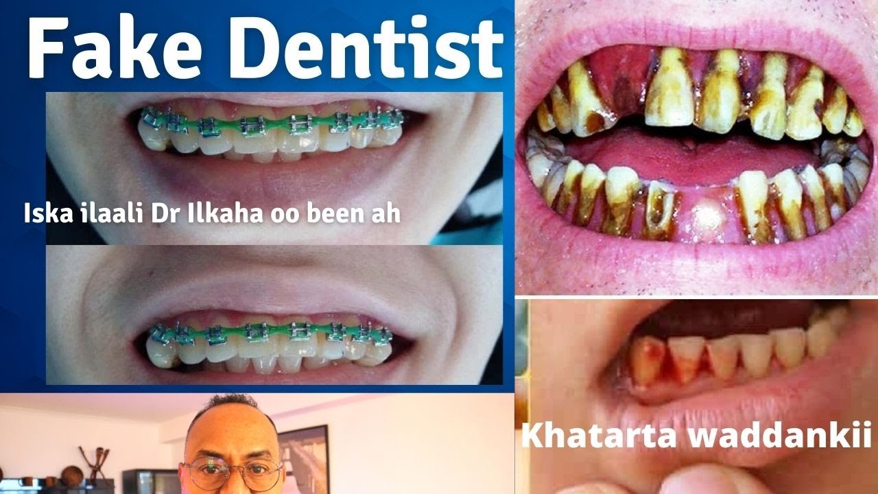 Iska ilaaliya Dr ka ilkaha oo beena. Fake Dantist. Yaab.