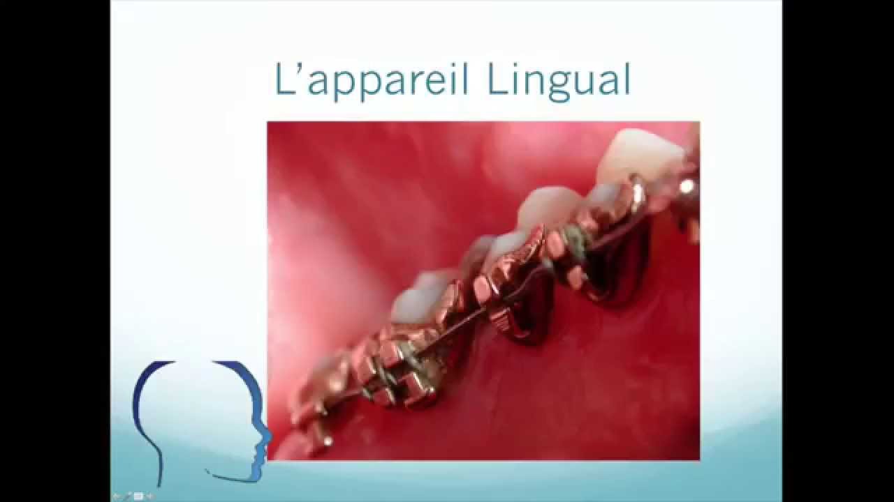 Orthodontie linguale: comment survivre ? Tutorial HQ