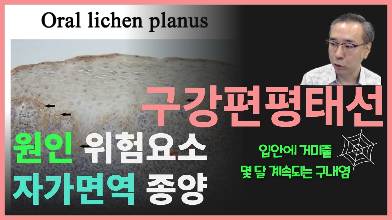 구강편평태선 원인, 자가면역질환과의 관련성 그리고 종양 발생 위험성은 어느정도 일까요?