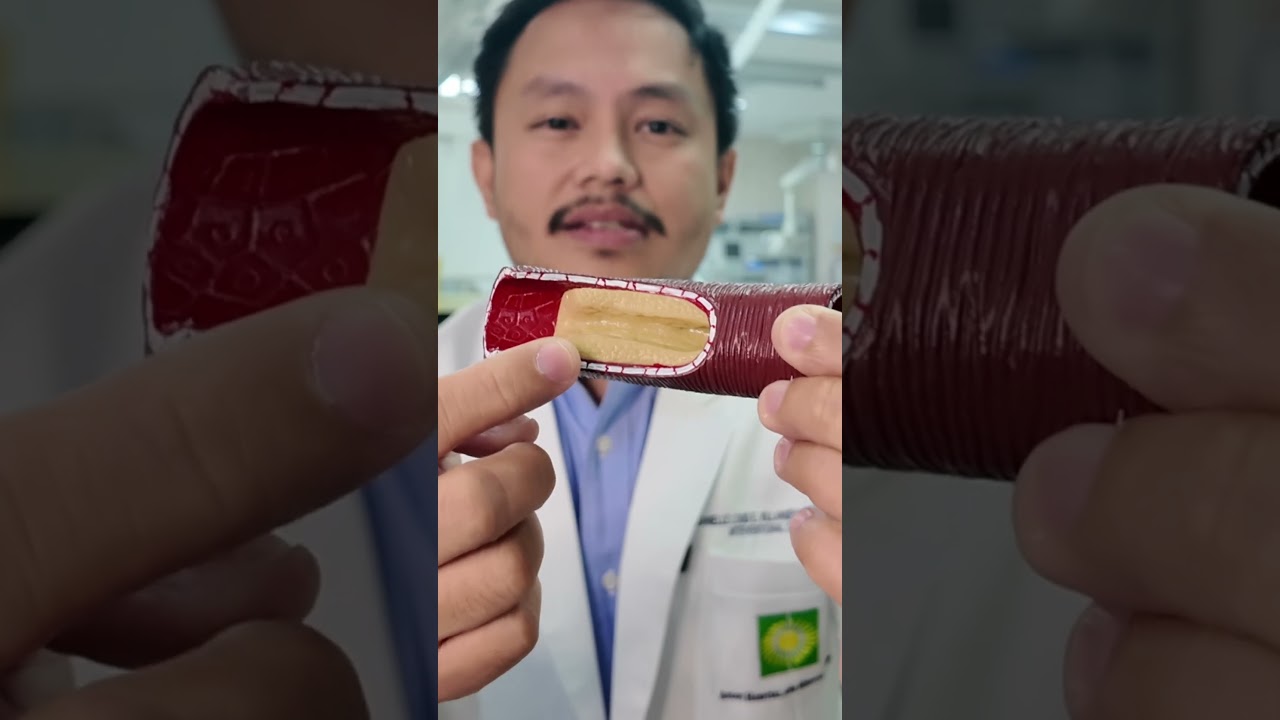 What is Atherosclerosis? | #BeatAteRose