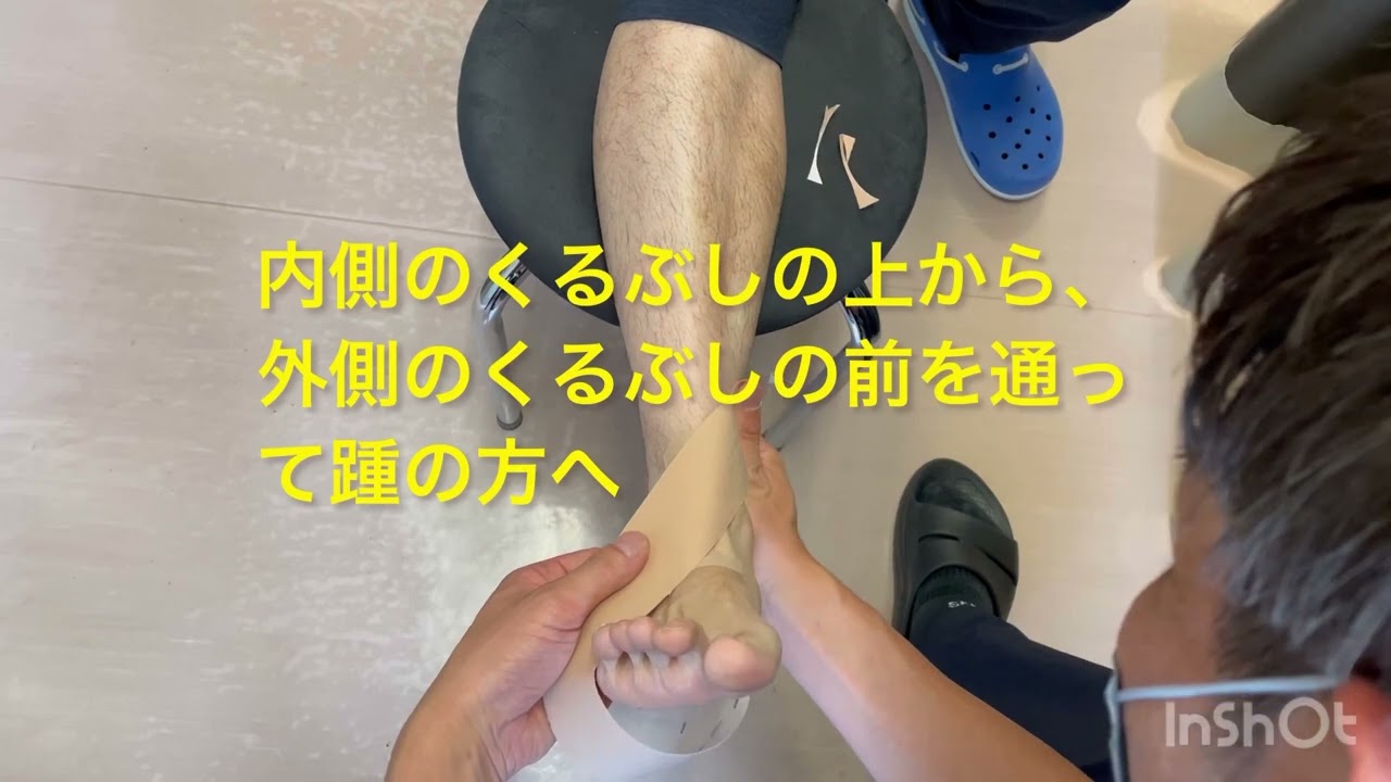 足関節捻挫のキネシオテーピング法