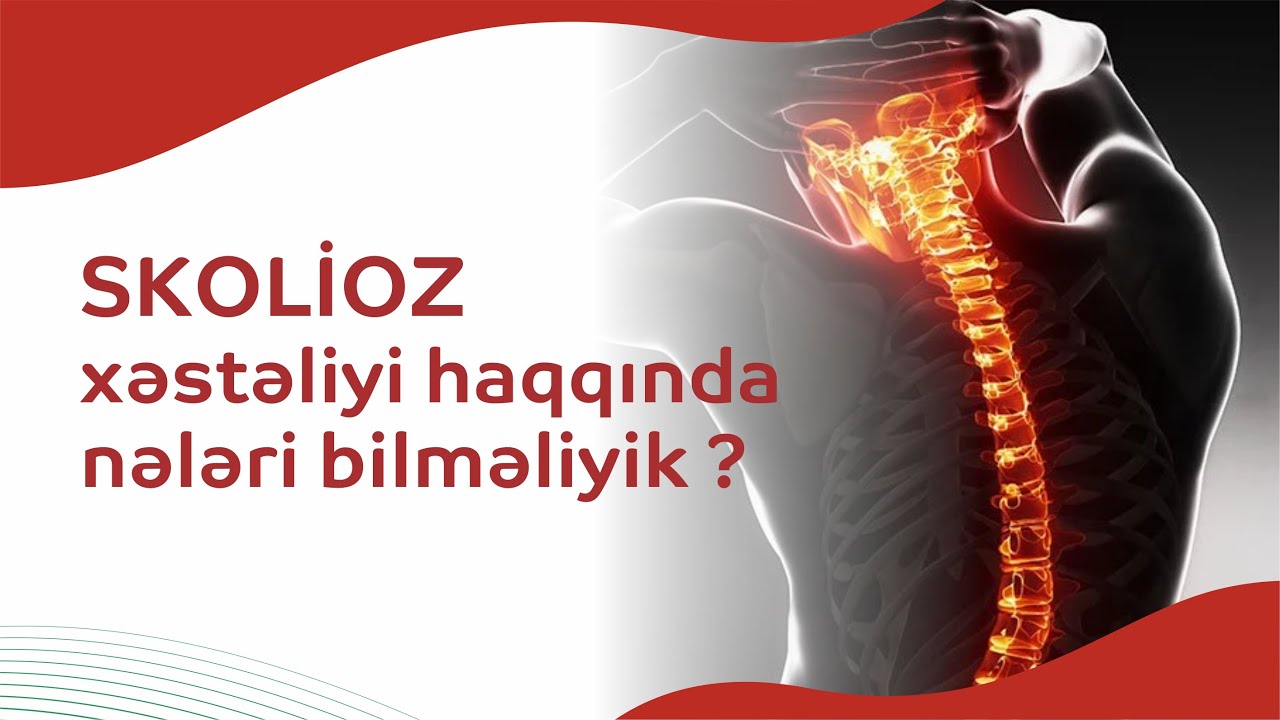 #Skolioz xəstəliyi haqqında nələri bilməliyik ?