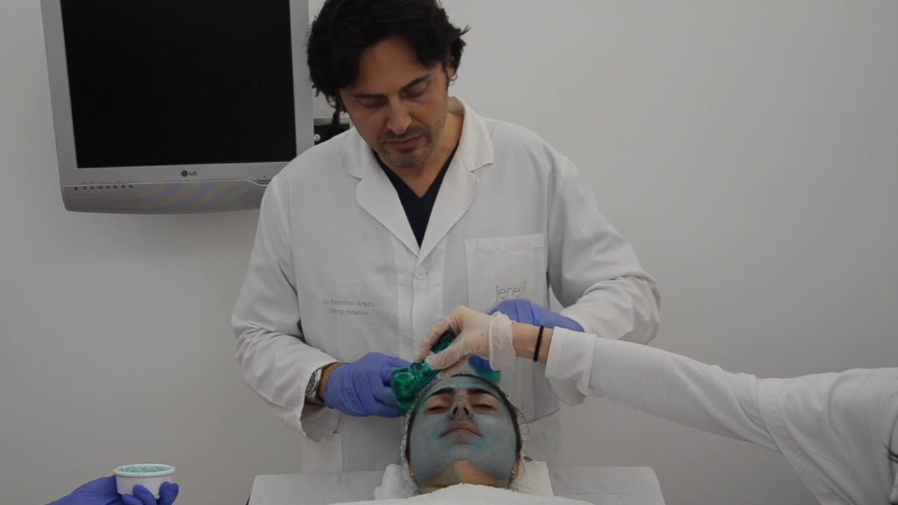 Tca Peeling  - Macchie del volto e Melasma