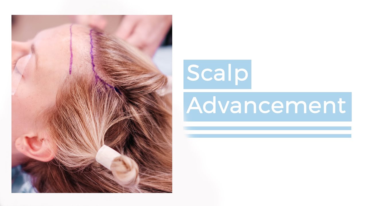 Hairline Lowering (Forehead Reduction) with Dr. Sarah Saxon