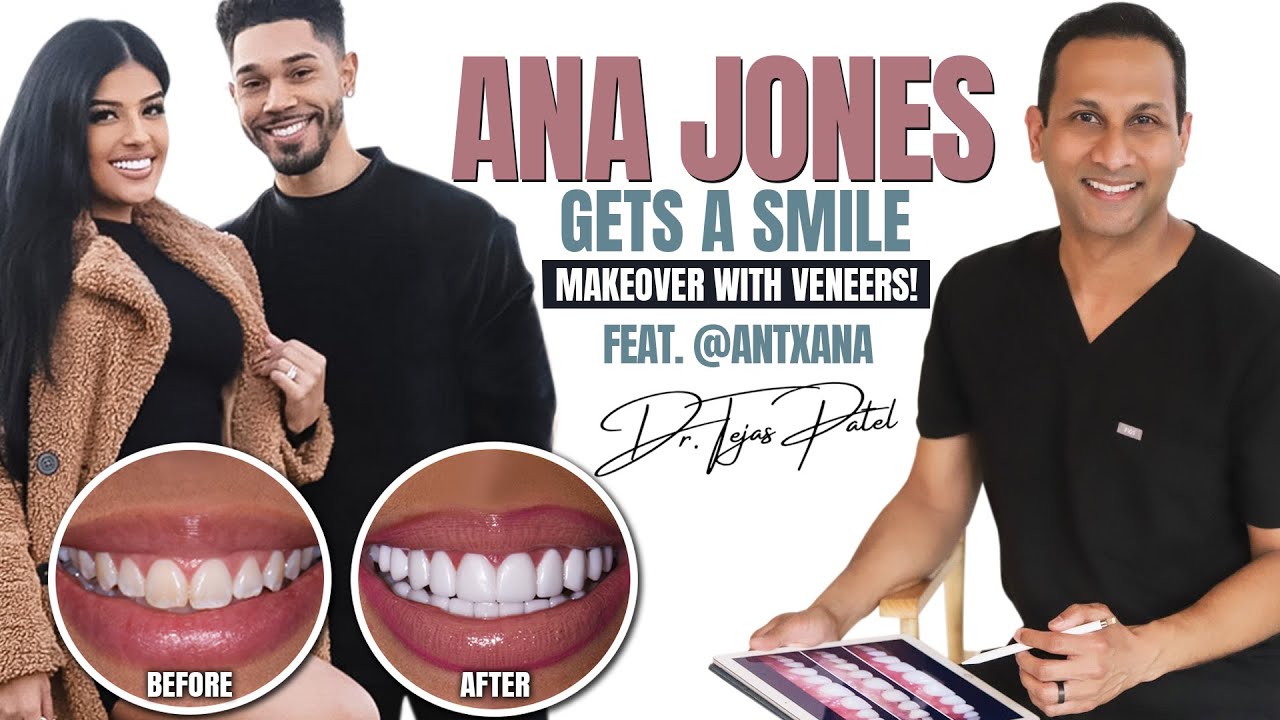 Ana Jones Gets a #SmileMakeover with Veneers! Feat. @AntXAna