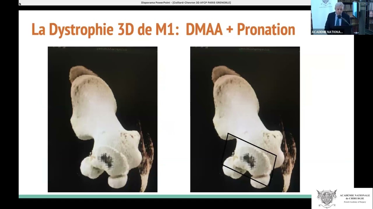 05 Dysmorphie du premier rayon dans l'hallux valgus