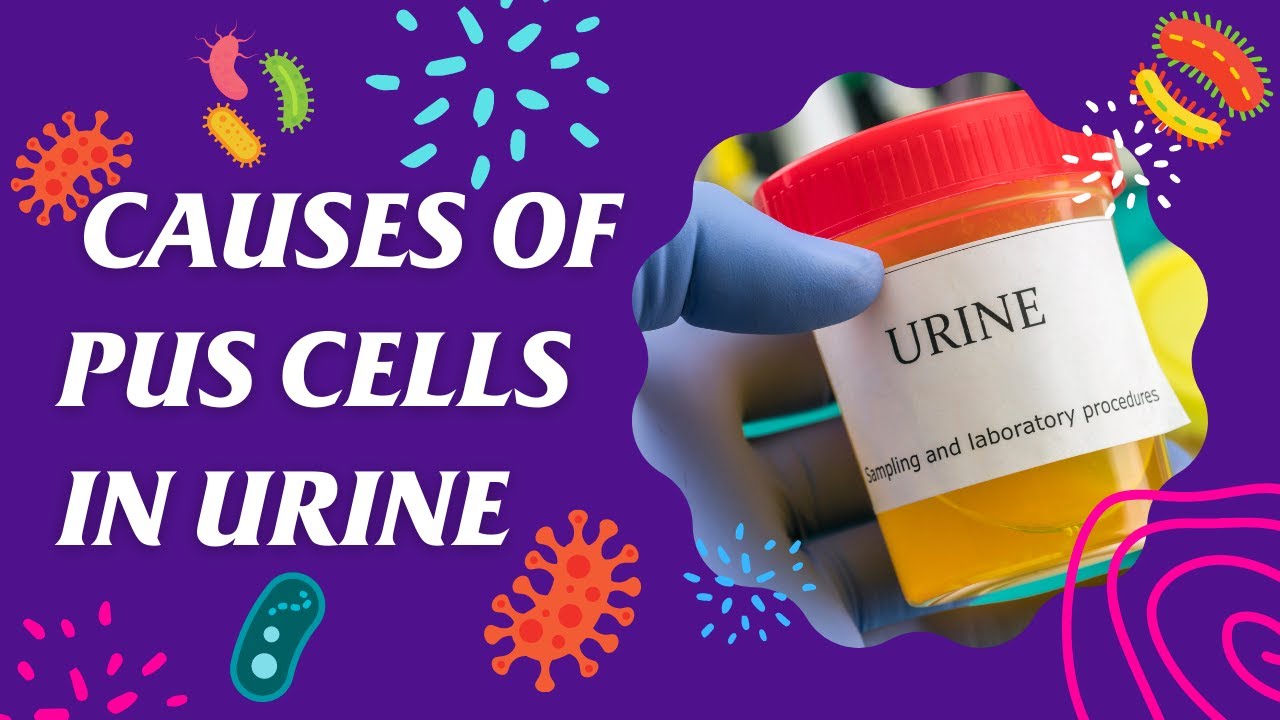 6 Main Causes of Pus Cells in Urine | Urinary tract infection | Pyuria