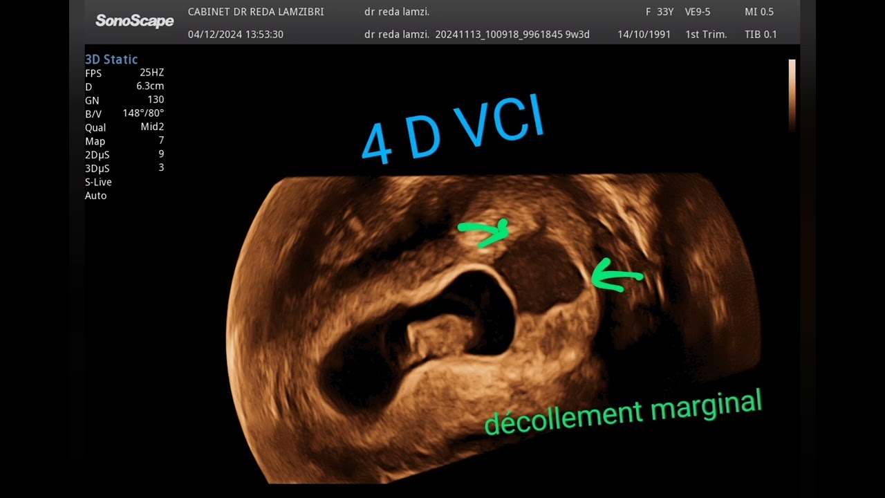 ✅️ Décollement en début de 🫄 (9 SA ) 👉 images et explications 🤔