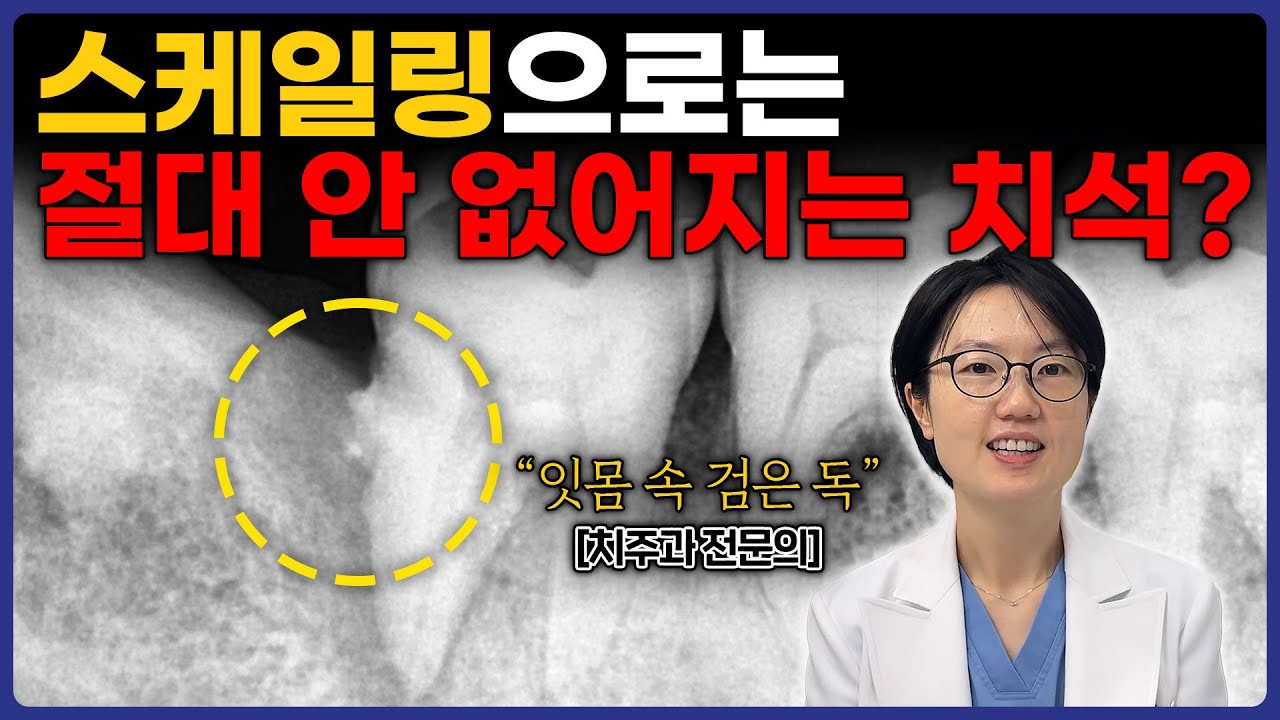 그냥 두면 이빨 뽑아야 할 수 있습니다, 스케일링 말고 '이것'하세요