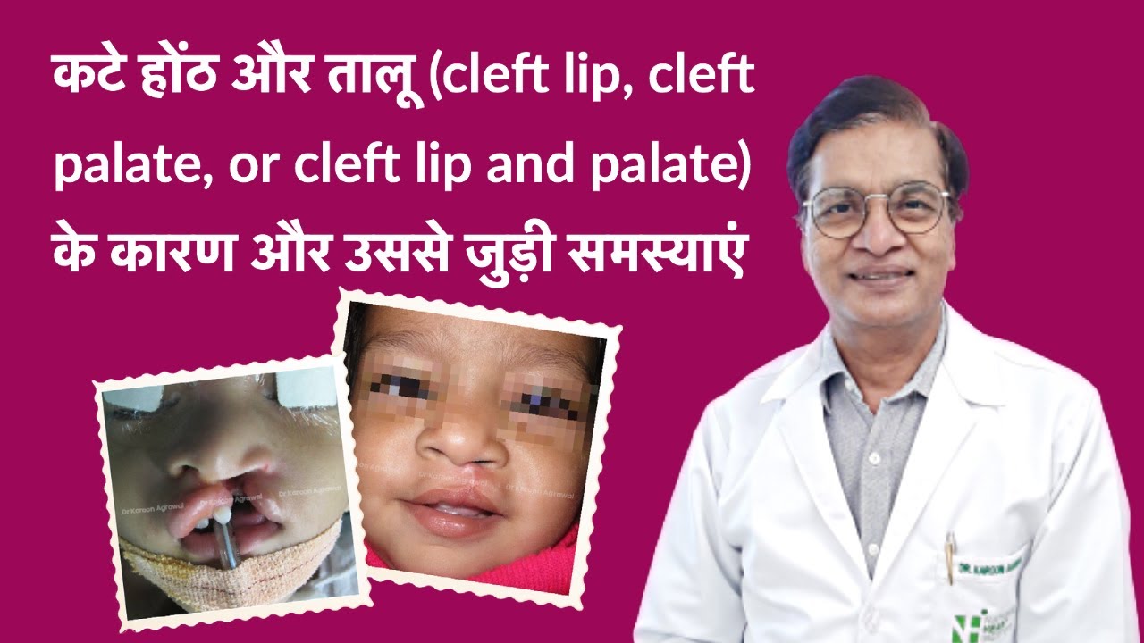Cleft Lip and Palate  in Hindi: कटे होंठ और तालू के कारण और Cleft से जुड़ी समस्याएं #CleftPalate