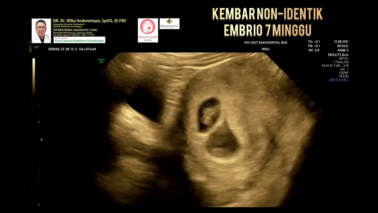 kembar non identik 7 weeks