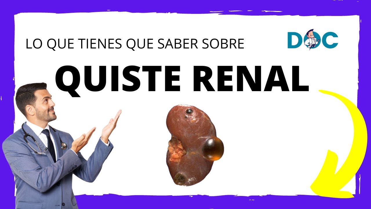 Quistes Renales Simples: TODO LO QUE TIENES QUE SABER.
