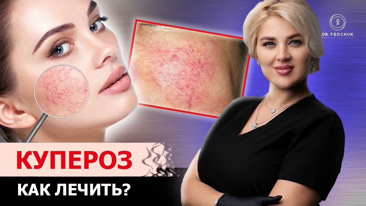 Как избавиться от сосудов на лице? Советы врача - косметолога