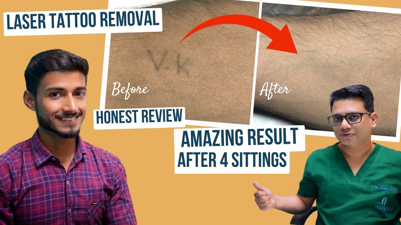 Laser Tattoo Removal Result After 4 Sittings | Honest Review | 