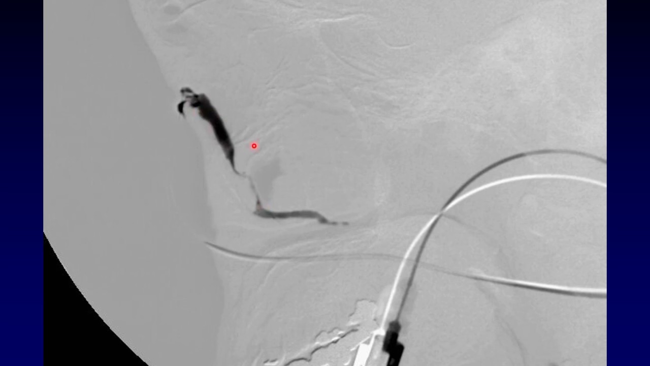 Imaging of the Eye and Orbit, Part 6